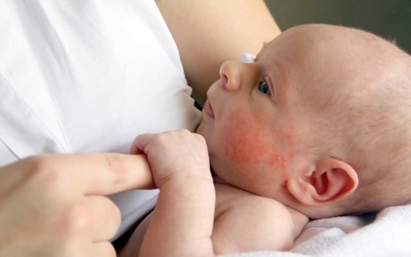 آکنه نوزادی چیست